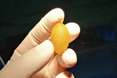 余生，“肝膽相照”——新式內(nèi)鏡微創(chuàng)保膽手術(shù)